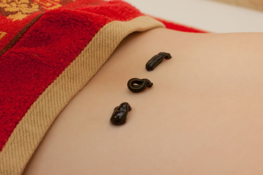 leeches in the lower back with osteochondrosis