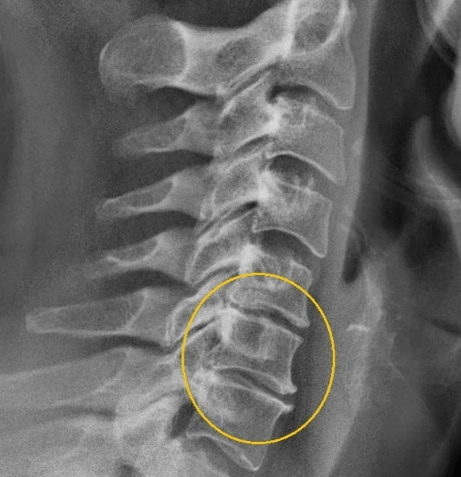 cervical osteochondrosis